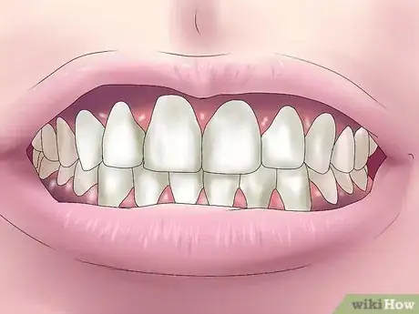 Imagen titulada Reverse Dental Bone Loss Step 12