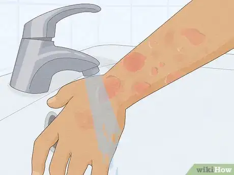 Imagen titulada Recognize Hives (Rash) Step 9