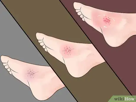 Imagen titulada Treat a Sea Urchin Sting Step 10