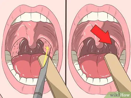 Imagen titulada Remove Tonsil Stones (Tonsilloliths) Step 17
