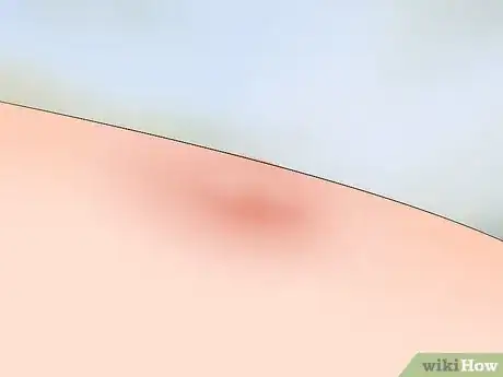 Imagen titulada Identify Tick Bites Step 3