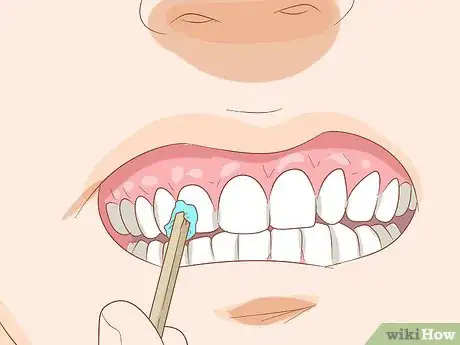 Imagen titulada Hide Tooth Decay Step 8