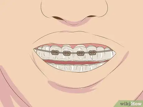 Imagen titulada Make Fake Braces or a Fake Retainer Step 16