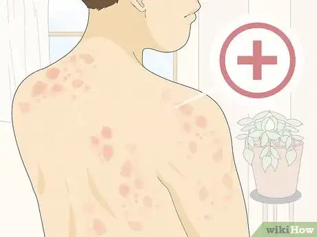 Imagen titulada Recognize Hives (Rash) Step 8