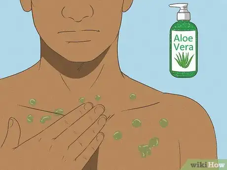 Imagen titulada Get Rid of a Mosquito Bite Step 6