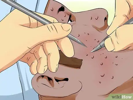 Imagen titulada Treat Chicken Pox Scars Step 1