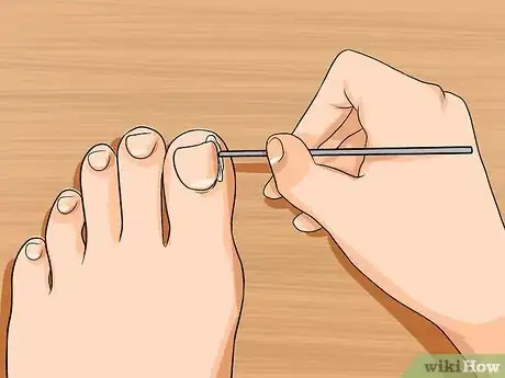 Imagen titulada Relieve Ingrown Toe Nail Pain Step 17