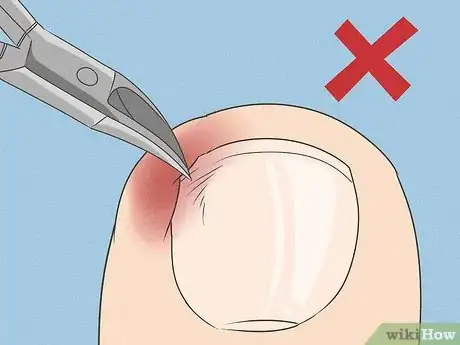 Imagen titulada Will an Ingrown Toenail Heal Itself Step 7