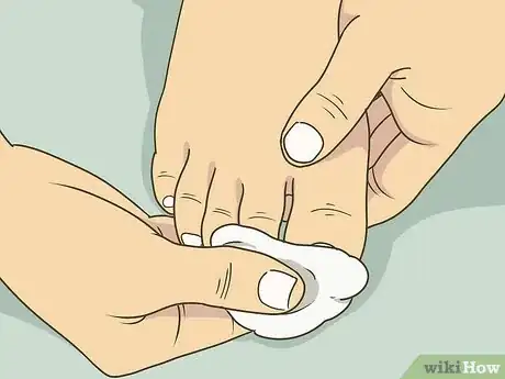 Imagen titulada Soak an Ingrown Toenail Step 6