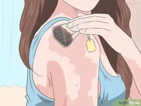 Imagen titulada Get Rid of Sunburn Fast Step 9