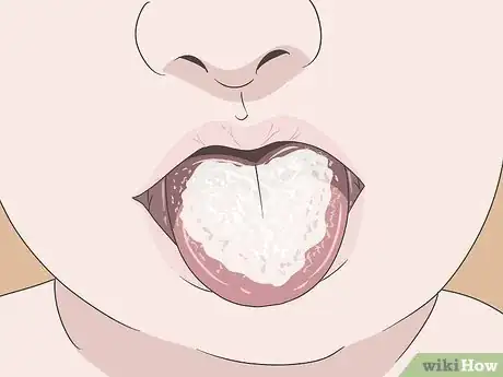 Imagen titulada Know if You Have Oral Thrush Step 1