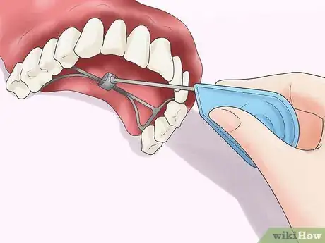 Imagen titulada Deal With a Palate Expander Step 11