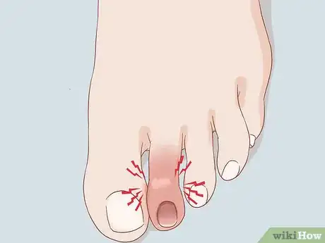 Imagen titulada Treat a Swollen Toe Step 4