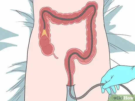 Imagen titulada Diagnose a Fistula Step 9