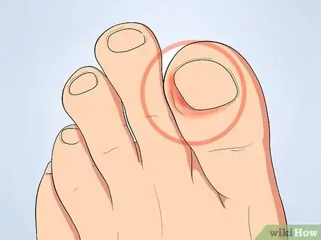 Imagen titulada Tell if an Ingrown Toenail Is Infected Step 1