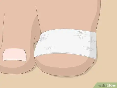 Imagen titulada Relieve Ingrown Toe Nail Pain Step 19