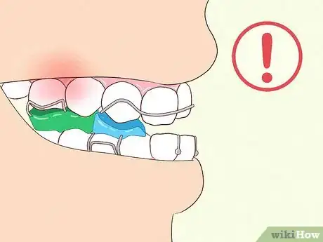 Imagen titulada Cope with Twin Block Braces Step 13