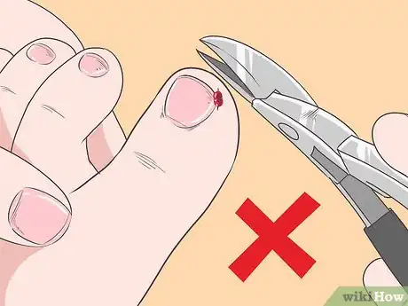 Imagen titulada Fix Thick Toenails Step 4