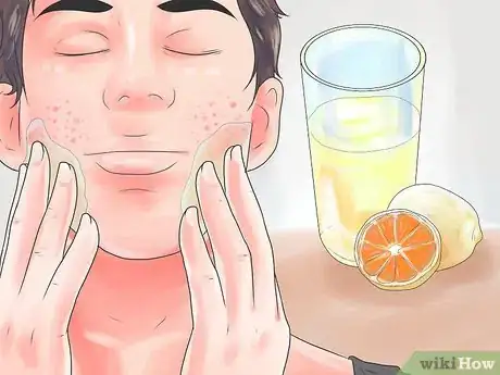 Imagen titulada Get Rid of Acne Scars Fast Step 1
