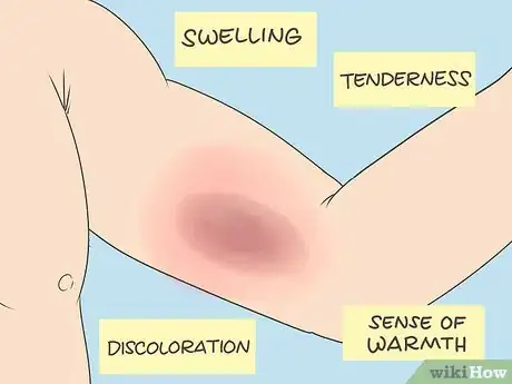 Imagen titulada Dissolve Blood Clots Step 2