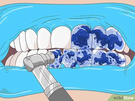 Imagen titulada Remove Brown Stains from Teeth Step 7