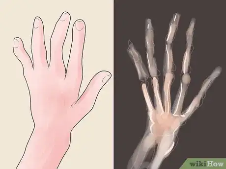 Imagen titulada Care for Arthritic Hands Step 14