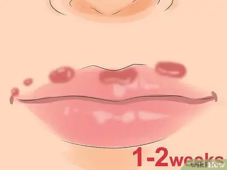 Imagen titulada Test for Herpes Step 8