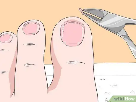 Imagen titulada Fix Thick Toenails Step 3