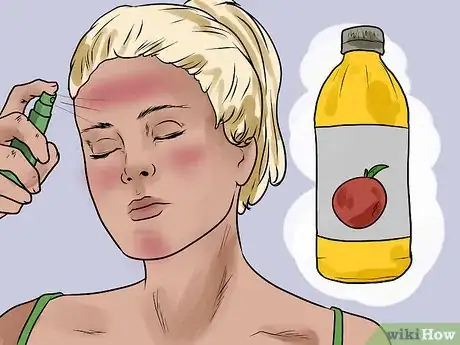 Imagen titulada Prevent Skin Peeling After Sunburn Step 8