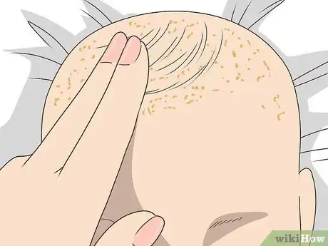 Imagen titulada Get Rid of Cradle Cap Step 1