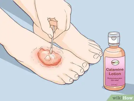Imagen titulada Get Rid of Poison Ivy Rashes Step 8