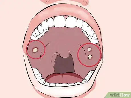 Imagen titulada Recognize Signs of Oral Cancer Step 2