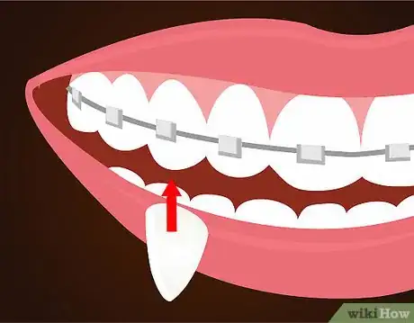 Imagen titulada Make Vampire Fangs if You Have Braces Step 10