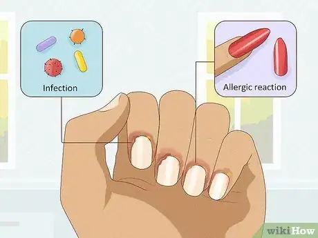 Imagen titulada Stop Itchy Cuticles Step 1