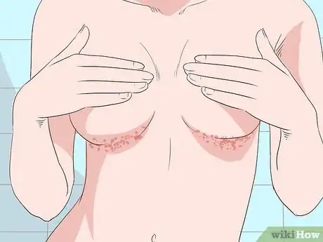 Imagen titulada Get Rid of a Rash Under Breasts Step 6