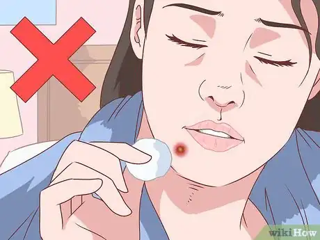 Imagen titulada Stop a Zit from Bleeding Step 10