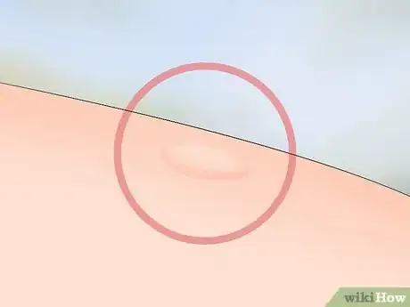 Imagen titulada Identify Tick Bites Step 2