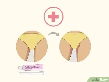 Imagen titulada Get Rid of a Yeast Infection at Home Step 18