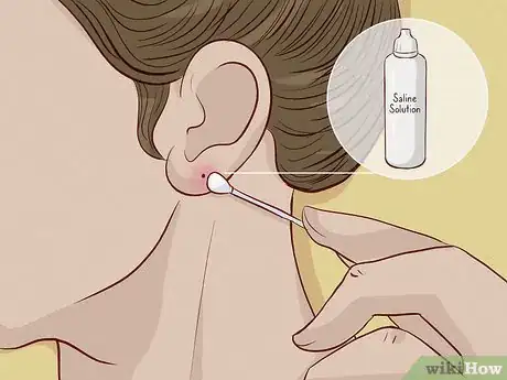 Imagen titulada Close an Earlobe Piercing Step 2