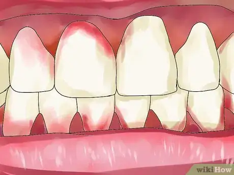 Imagen titulada Reverse Dental Bone Loss Step 14