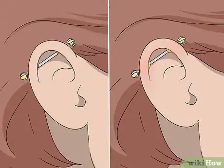 Imagen titulada Heal an Industrial Piercing Step 13