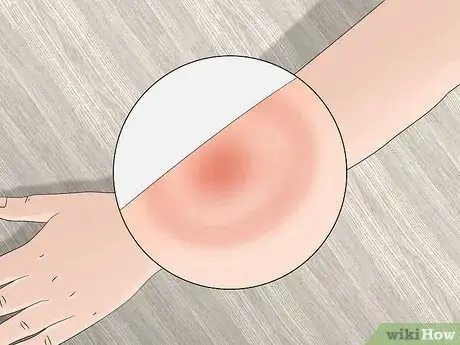 Imagen titulada Identify Tick Bites Step 7