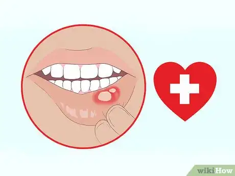 Imagen titulada Get Rid of Mouth Blisters Step 12