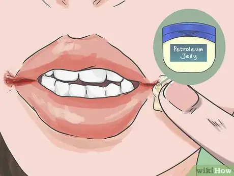 Imagen titulada Heal Cracks in the Corners of Your Mouth Step 1