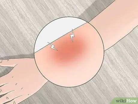 Imagen titulada Identify Tick Bites Step 5