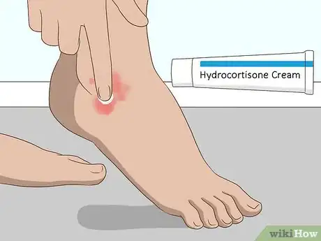 Imagen titulada Reduce Bug Bite Swelling Step 11