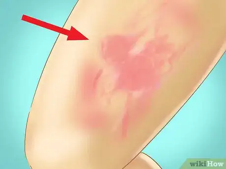 Imagen titulada Recognize Hives (Urticaria) Step 2