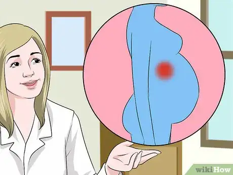 Imagen titulada Detect Appendicitis During Pregnancy Step 3