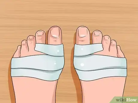 Imagen titulada Get Rid of Bunions Step 6