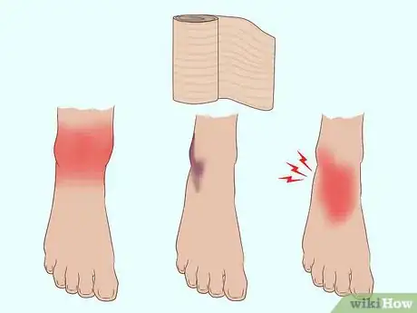 Imagen titulada Wrap an Ankle with an ACE Bandage Step 10